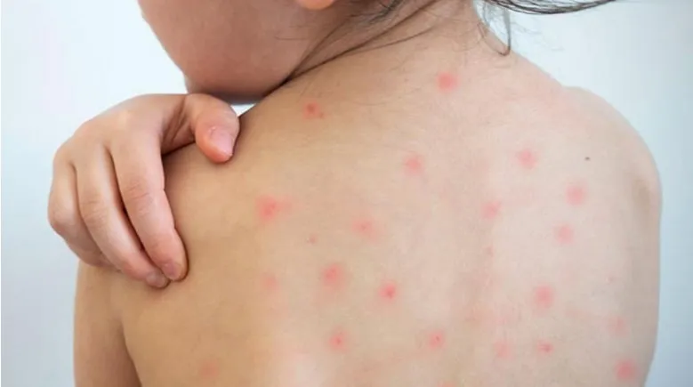 শেবাচিম হাসপাতালে হামের উপসর্গ নিয়ে শিশুর মৃত্যু